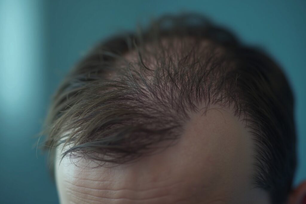 Haarausfall erkennen und effektiv behandeln