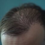 Haarausfall erkennen und effektiv behandeln